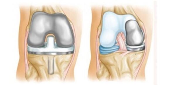 arthroplasty for arthrosis of the knee joint