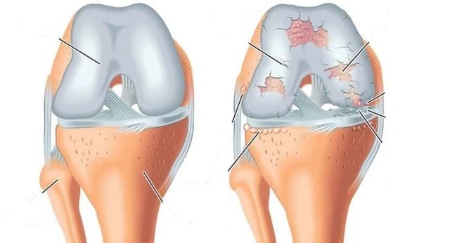 healthy joint and arthrosis of the knee joint