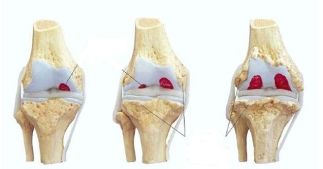 stages of arthrosis of the knee joint