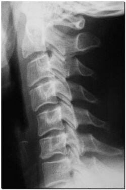X-ray of the cervical spine