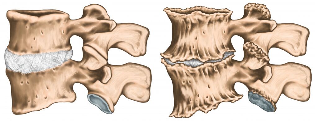 back pain due to spinal injury