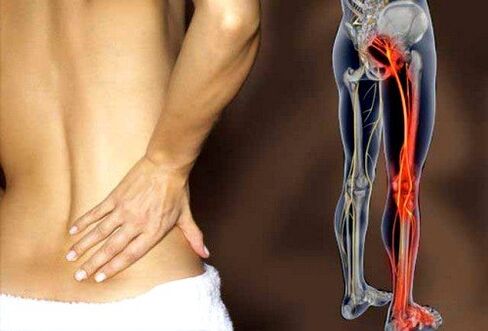 lower back pain due to inflammation of the sciatic nerve