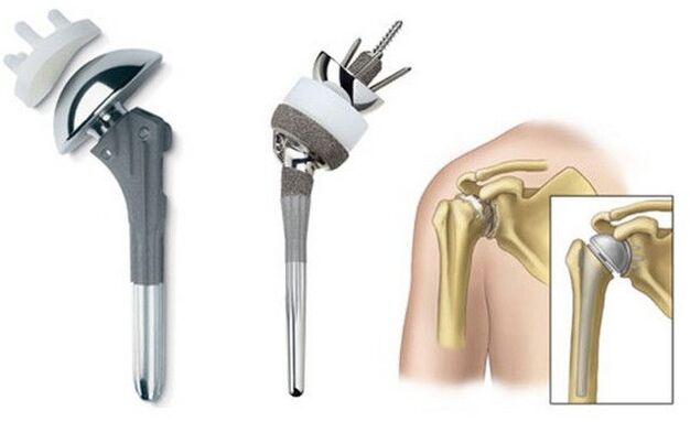 Endoprosthesis replacement is performed when the motor function of the shoulder is partially or completely lost