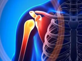 Inflamed shoulder joint due to arthrosis - a chronic disease of the musculoskeletal system