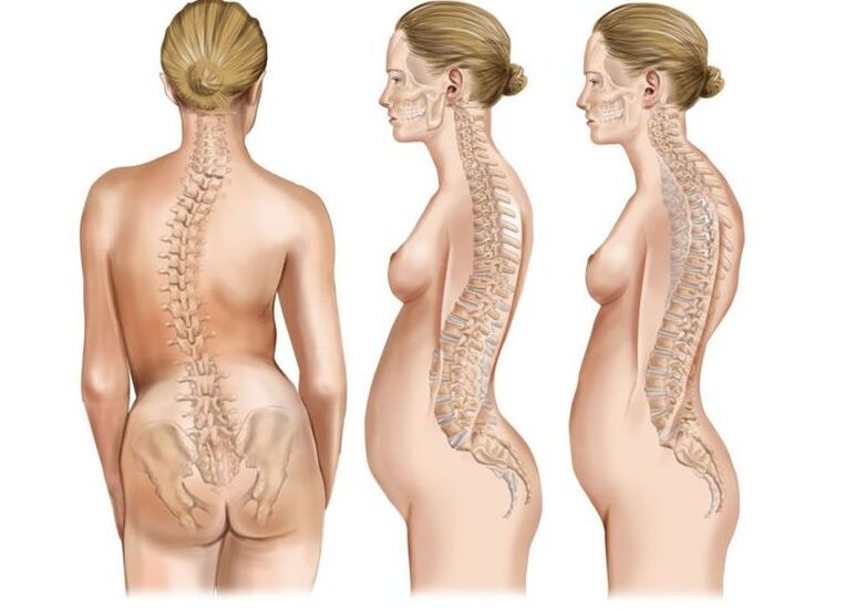 pain in the shoulder blades due to scoliosis