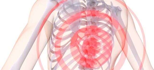 Localization of pain in breast chondrosis
