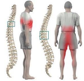 Pain with thoracic chondrosis can be given to the lower limbs and crotch
