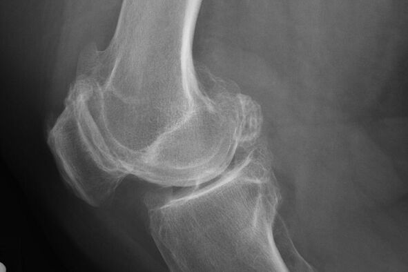 Methods for diagnosing knee arthrosis