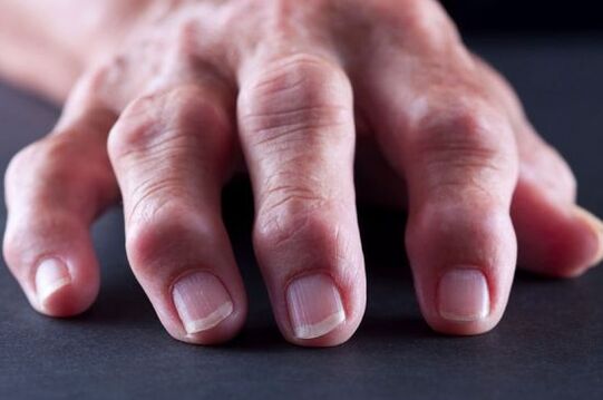deformation of the joints of the fingers with arthritis and arthrosis