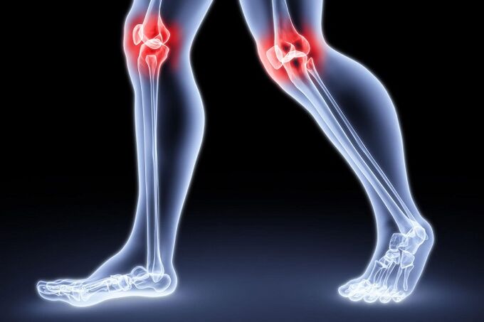 knee pain due to arthritis and arthrosis
