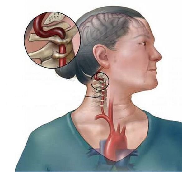 vertebral artery syndrome with cervical osteochondrosis