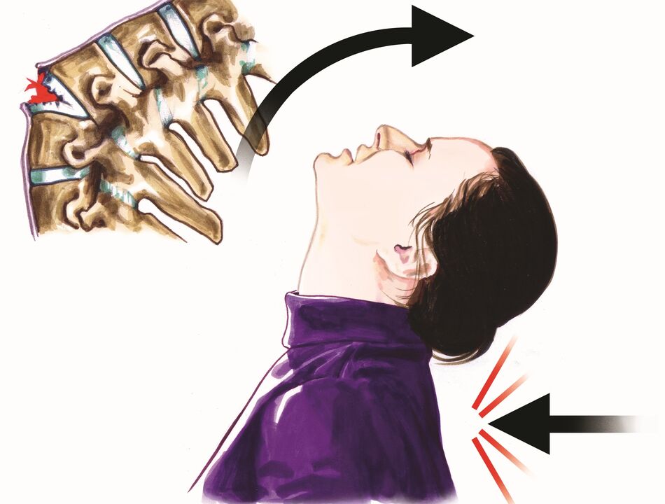 spinal damage as a cause of neck pain