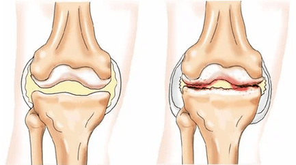 Chondromatosis